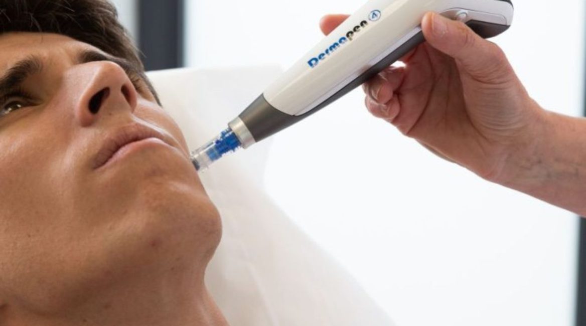 microneedling peaux matures bonne option