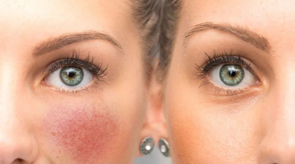 laser erythrose flushes